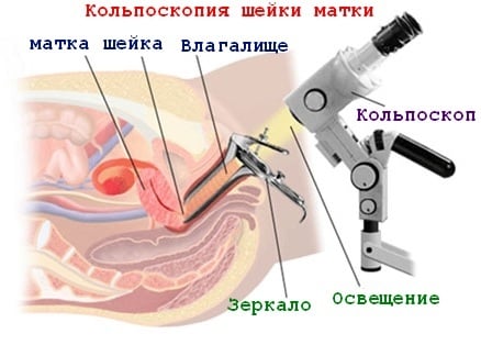 Кольпоскопия